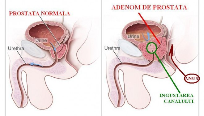 Realizarea in premiera a unei proceduri de terapie minim invaziva prin embolizare a patologiei prostatice Realizarea in premiera a unei proceduri de terapie minim invaziva prin embolizare a patologiei prostatice