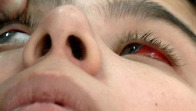 Un dispozitiv ce reda partial vederea bolnavilor de retinita pigmentara a fost experimentat cu succes Un dispozitiv ce reda partial vederea bolnavilor de retinita pigmentara a fost experimentat cu succes