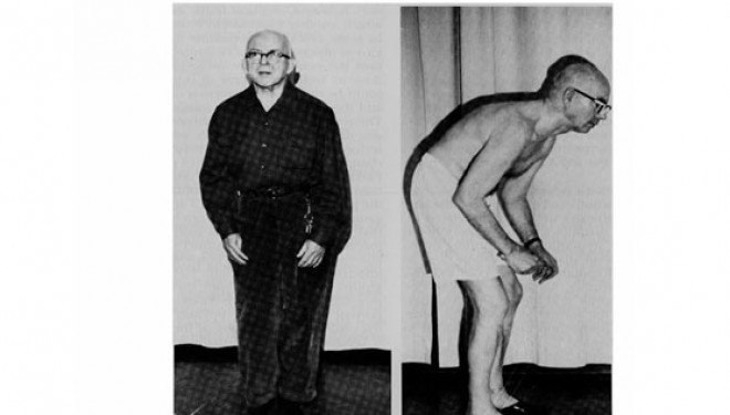 Tratamentul recomandat pentru Parkinson poate provoca tulburari de comportament Tratamentul recomandat pentru Parkinson poate provoca tulburari de comportament