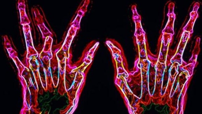 Artrita psoriazica – cauze si tratament Artrita psoriazica – cauze si tratament