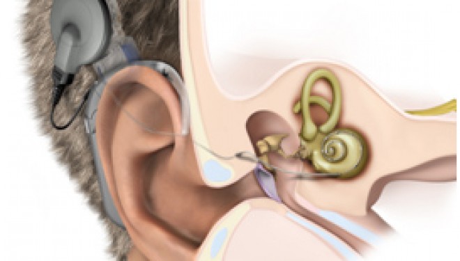 Premiera in medicina romaneasca:implantare bilaterala cu noul implant cohlear Cochlear Nucleus Profile Series, la M.S. Curie Premiera in medicina romaneasca:implantare bilaterala cu noul implant cohlear Cochlear Nucleus Profile Series, la M.S. Curie