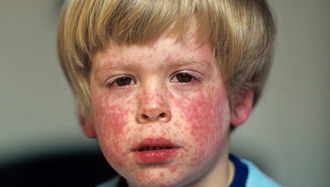 Epidemia de pojar, inca o dovada a ignorantei periculoase Epidemia de pojar, inca o dovada a ignorantei periculoase