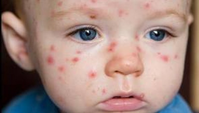 Epidemie de rujeola in Romania din cauza nevaccinarii Epidemie de rujeola in Romania din cauza nevaccinarii