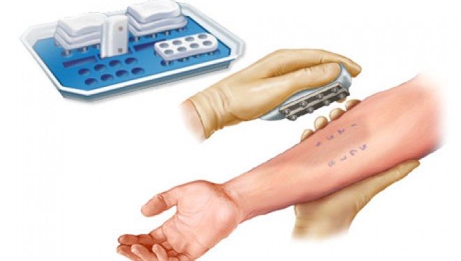 Cu un test de piele se poate depista boala Alzheimer si Parkinson in stadii initiale Cu un test de piele se poate depista boala Alzheimer si Parkinson in stadii initiale