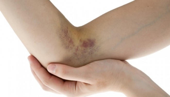 Medicii atrag atentia asupra unei boli autoimune care afecteaza mii de femei tinere si copii Medicii atrag atentia asupra unei boli autoimune care afecteaza mii de femei tinere si copii