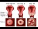 Femeile ignora si acum riscul de cancer de col uterin