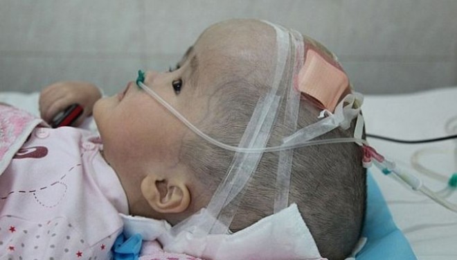 O fetita de 3 ani, diagosticata cu hidrocefalie, a suferit primul transplant de cutie craniana din lume O fetita de 3 ani, diagosticata cu hidrocefalie, a suferit primul transplant de cutie craniana din lume