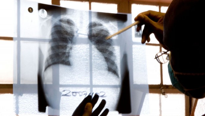 TUBERCULOZA ! România raportează anual aproximativ 13.000 de cazuri noi TUBERCULOZA ! România raportează anual aproximativ 13.000 de cazuri noi