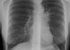 La ce chinuri sunt supuși bolnavii de TBC în România