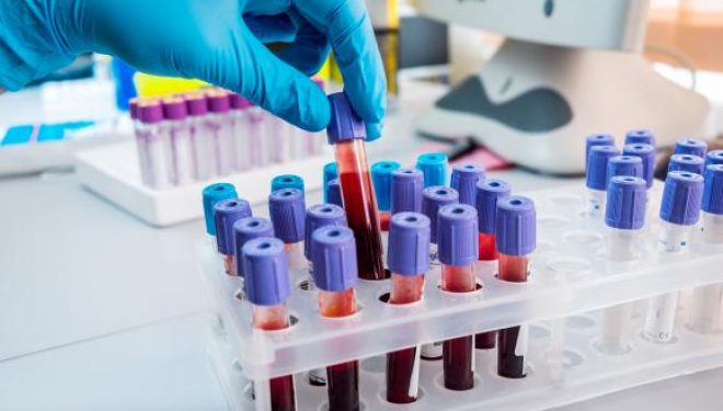 Un test de sânge ar putea detecta riscul apariției de Alzheimer Un test de sânge ar putea detecta riscul apariției de Alzheimer