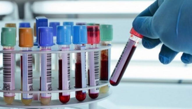 Test de sânge
care ar putea ajuta la tratamentul potrivit în cancerul de sân