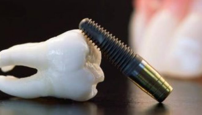 Când este cel mai potrivit moment să optezi pentru un implant dentar Când este cel mai potrivit moment să optezi pentru un implant dentar