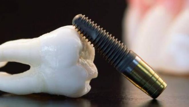 Când este cel mai potrivit moment să optezi pentru un implant dentar Când este cel mai potrivit moment să optezi pentru un implant dentar