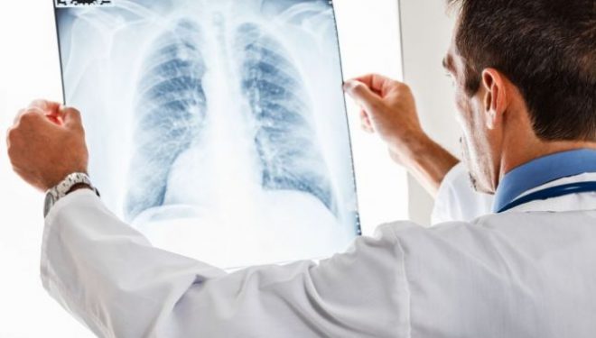 28 de români mor de cancer la plămâni, în fiecare zi. „75% din
totalul cazurilor de cancer pulmonar sunt diagnosticate în stadiu inoperabil“ 28 de români mor de cancer la plămâni, în fiecare zi. „75% din
totalul cazurilor de cancer pulmonar sunt diagnosticate în stadiu inoperabil“