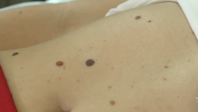 Cum recunoașteți alunițele periculoase. Medicii recomandă să mergeți imediat la control Cum recunoașteți alunițele periculoase. Medicii recomandă să mergeți imediat la control
