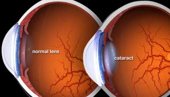 Doi în unu: operaţie de tratare a cataractei şi de
corectare a viciilor de refracţie Doi în unu: operaţie de tratare a cataractei şi de
corectare a viciilor de refracţie