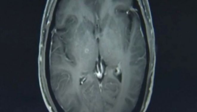 Cazul unui bărbat care s-a prezentat la spital cu dureri de cap şi crize epileptice. Diagnosticul uluitor pus de medici Cazul unui bărbat care s-a prezentat la spital cu dureri de cap şi crize epileptice. Diagnosticul uluitor pus de medici