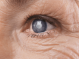 Cataracta, boala ochilor opaci. Laserul, tehnica performantă de operație a afecțiunii oculare